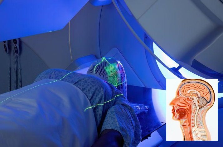 সতর্ক হলে ‘হেড অ্যান্ড নেক ক্যান্সার’ থেকে মুক্তি মেলে